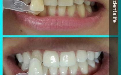Blanqueamiento Dental en Veracruz