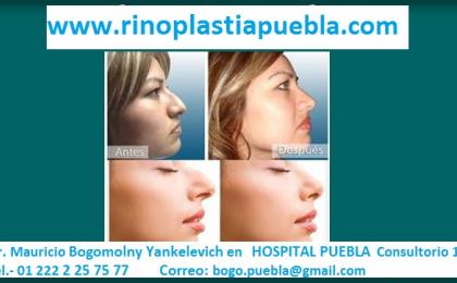 Rinoplastia Puebla